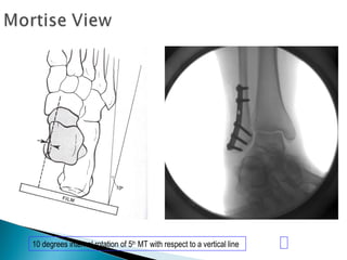 10 degrees internal rotation of 5th
MT with respect to a vertical line
 