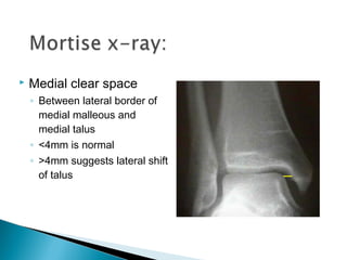  Medial clear space
◦ Between lateral border of
medial malleous and
medial talus
◦ <4mm is normal
◦ >4mm suggests lateral shift
of talus
 