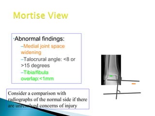 •Abnormal findings:
–Medial joint space
widening
–Talocrural angle: <8 or
>15 degrees
–Tibia/fibula
overlap:<1mm
Consider a comparison with
radiographs of the normal side if there
are unresolved concerns of injury
 