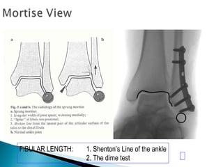 FIBULAR LENGTH: 1. Shenton’s Line of the ankle
2. The dime test
 