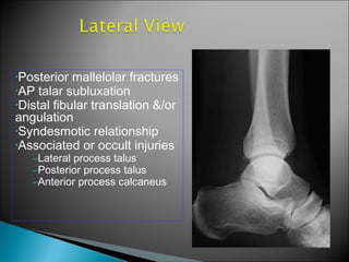 •Posterior mallelolar fractures
•AP talar subluxation
•Distal fibular translation &/or
angulation
•Syndesmotic relationship
•Associated or occult injuries
–Lateral process talus
–Posterior process talus
–Anterior process calcaneus
 