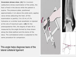 Inversion stress view. (A) For inversion
(adduction)-stress examination of the ankle, the
foot is fixed in the device while the patient is
supine. The pressure plate, positioned
approximately 2 cm above the ankle joint, applies
varus stress adducting the heel. (If the
examination is painful, 5 to 10 mL of 1%
Xylocaine or a similar local anesthetic is injected
at the site of maximum pain.) (B) On the
anteroposterior film, the degree of talar tilt is
measured by the angle formed by lines drawn
along the tibial plafond and the dome of the
talus. The contralateral ankle is subjected to the
same procedure for comparison.
This angle helps diagnose tears of the
lateral collateral ligament
 