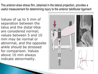 The anterior-draw stress film, obtained in the lateral projection, provides a
useful measurement for determining injury to the anterior talofibular ligament
Values of up to 5 mm of
separation between the
talus and the distal tibia
are considered normal;
values between 5 and 10
mm may be normal or
abnormal, and the opposite
ankle should be stressed
for comparison. Values
above 10 mm always
indicate abnormality.
 