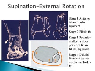 1
23
4
Stage 1 Anterior
tibio- fibular
ligament
Stage 2 Fibula fx
Stage 3 Posterior
malleolus fx or
posterior tibio-
fibular ligament
Stage 4 Deltoid
ligament tear or
medial malleolus
fx
 