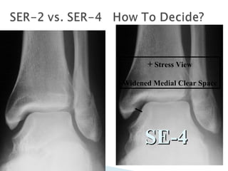  SER-2
 Negative Stress view
 External rotation of foot
with ankle in neutral
flexion (00
)
+ Stress View
Widened Medial Clear Space
SE-4SE-4
 