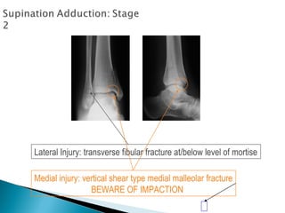 Lateral Injury: transverse fibular fracture at/below level of mortise
Medial injury: vertical shear type medial malleolar fracture
BEWARE OF IMPACTION
 