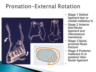  Stage 1 Deltoid
ligament tear or
medial malleolus fx
 Stage 2 Anterior
tibio-fibular
ligament and
interosseous
membrane
 Stage 3 Spiral,
proximal fibula
fracture
 Stage 4 Posterior
malleolus fx or
posterior tibio-
fibular ligament

34
1 2
 