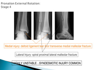 Medial injury: deltoid ligament tear &/or transverse medial malleolar fracture
Lateral Injury: spiral proximal lateral malleolar fracture
HIGHLY UNSTABLE…SYNDESMOTIC INJURY COMMON
 