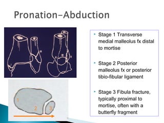 Stage 1 Transverse
medial malleolus fx distal
to mortise
 Stage 2 Posterior
malleolus fx or posterior
tibio-fibular ligament
 Stage 3 Fibula fracture,
typically proximal to
mortise, often with a
butterfly fragment
1
2 3
 