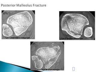 Type I- posterolateral oblique type Type II- medial extension type
Type III- small shell type
67% 19%
14%
 