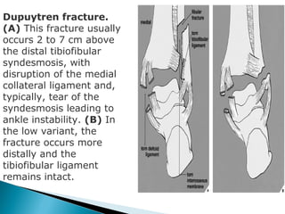 Dupuytren fracture.
(A) This fracture usually
occurs 2 to 7 cm above
the distal tibiofibular
syndesmosis, with
disruption of the medial
collateral ligament and,
typically, tear of the
syndesmosis leading to
ankle instability. (B) In
the low variant, the
fracture occurs more
distally and the
tibiofibular ligament
remains intact.
 