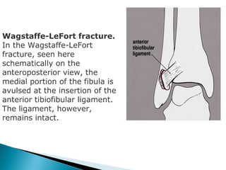 Wagstaffe-LeFort fracture.
In the Wagstaffe-LeFort
fracture, seen here
schematically on the
anteroposterior view, the
medial portion of the fibula is
avulsed at the insertion of the
anterior tibiofibular ligament.
The ligament, however,
remains intact.
 