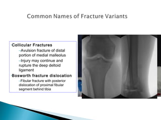 •Collicular Fractures
–Avulsion fracture of distal
portion of medial malleolus
–Injury may continue and
rupture the deep deltoid
ligament
•Bosworth fracture dislocation
–Fibular fracture with posterior
dislocation of proximal fibular
segment behind tibia
POSTERIOR COLLICULUS ANTERIOR COLLICULUS
INTERCOLLICULAR GROOVE
 