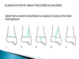 CLASSIFICATION OF ANKLE FRACTURES IN CHILDREN
Salter-Harris anatomic classification as applied to injuries of the distal
tibial epiphysis.
 