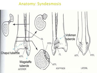 Chaput tubercle
Wagstaffe
tubercle
Volkman
tubercle
 