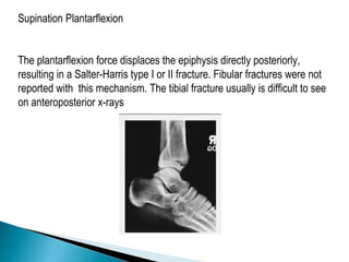 Supination Plantarflexion
The plantarflexion force displaces the epiphysis directly posteriorly,
resulting in a Salter-Harris type I or II fracture. Fibular fractures were not
reported with this mechanism. The tibial fracture usually is difficult to see
on anteroposterior x-rays
 