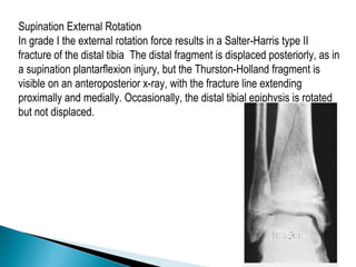 Supination External Rotation
In grade I the external rotation force results in a Salter-Harris type II
fracture of the distal tibia The distal fragment is displaced posteriorly, as in
a supination plantarflexion injury, but the Thurston-Holland fragment is
visible on an anteroposterior x-ray, with the fracture line extending
proximally and medially. Occasionally, the distal tibial epiphysis is rotated
but not displaced.
 