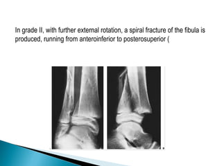 In grade II, with further external rotation, a spiral fracture of the fibula is
produced, running from anteroinferior to posterosuperior (
 