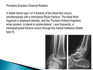 Pronation Eversion External Rotation
A Salter-Harris type I or II fracture of the distal tibia occurs
simultaneously with a transverse fibular fracture. The distal tibial
fragment is displaced laterally, and the Thurston-Holland fragment,
when present, is lateral or posterolateral . Less frequently, a
transepiphyseal fracture occurs through the medial malleolus (Salter
type II).
 
