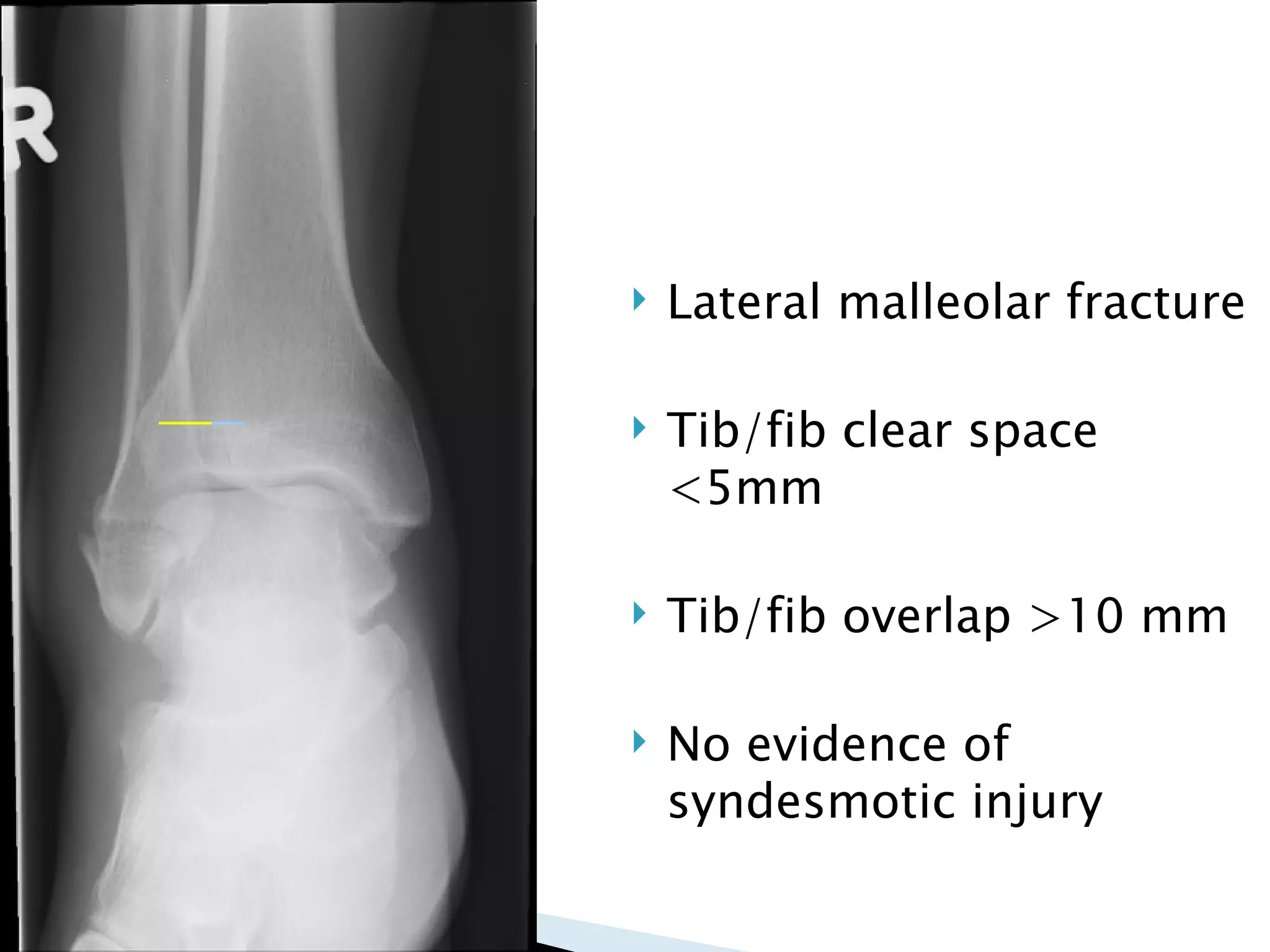 Ankle fractures final | PPT