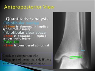 Quantitative analysis
◦Tibiofibular overlap
◦<10mm is abnormal - implies
syndesmotic injury
◦Tibiofibular clear space
◦>5mm is abnormal - implies
syndesmotic injury
◦Talar tilt
◦>2mm is considered abnormal


Consider a comparison with
radiographs of the normal side if there
are unresolved concerns of injury
 