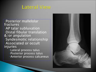 •Posterior   mallelolar
fractures
•AP talar subluxation
•Distal fibular translation
&/or angulation
•Syndesmotic relationship
•Associated or occult
injuries
  –Lateral process talus
  –Posterior process talus
  –Anterior process calcaneus
 