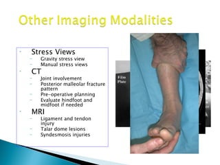 •   Stress Views
    –   Gravity stress view
    –   Manual stress views
•   CT
    –   Joint involvement
    –   Posterior malleolar fracture
        pattern
    –   Pre-operative planning
    –   Evaluate hindfoot and
        midfoot if needed
•   MRI
    –   Ligament and tendon
        injury
    –   Talar dome lesions
    –   Syndesmosis injuries
 