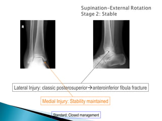 Lateral Injury: classic posterosuperioranteroinferior fibula fracture

              Medial Injury: Stability maintained

                    Standard: Closed management
 