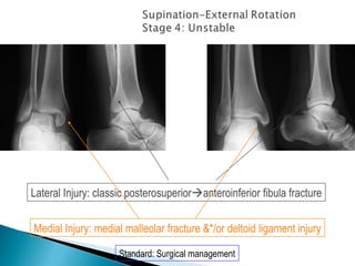 Lateral Injury: classic posterosuperioranteroinferior fibula fracture


Medial Injury: medial malleolar fracture &*/or deltoid ligament injury

                     Standard: Surgical management
 