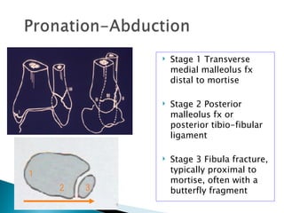    Stage 1 Transverse
                medial malleolus fx
                distal to mortise

               Stage 2 Posterior
                malleolus fx or
                posterior tibio-fibular
                ligament

               Stage 3 Fibula fracture,
1               typically proximal to
                mortise, often with a
    2   3       butterfly fragment
 