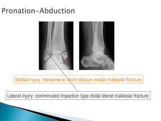 Medial injury: tranverse to short oblique medial malleolar fracture


Lateral Injury: comminuted impaction type distal lateral malleolar fracture
 