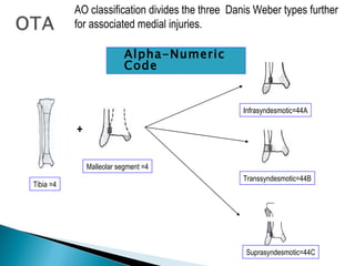 AO classification divides the three Danis Weber types further
           for associated medial injuries.

                          Alpha-Numeric
                           Code


                                                  Infrasyndesmotic=44A

           +


               Malleolar segment =4
                                                  Transsyndesmotic=44B
Tibia =4




                                                  Suprasyndesmotic=44C
 