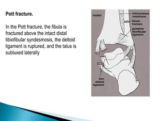 Pott fracture.

In the Pott fracture, the fibula is
fractured above the intact distal
tibiofibular syndesmosis, the deltoid
ligament is ruptured, and the talus is
subluxed laterally
 