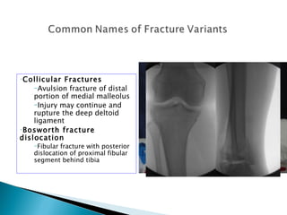 •Collicular  Fractures                                        INTERCOLLICULAR GROOVE

    –Avulsion fracture of distal
    portion of medial malleolus
    –Injury may continue and
    rupture the deep deltoid
    ligament
•Bosworth fracture                     POSTERIOR COLLICULUS               ANTERIOR COLLICULUS


dislocation
    –Fibular fracture with posterior
    dislocation of proximal fibular
    segment behind tibia
 