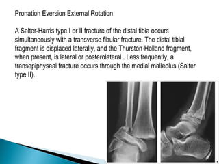 Pronation Eversion External Rotation

A Salter-Harris type I or II fracture of the distal tibia occurs
simultaneously with a transverse fibular fracture. The distal tibial
fragment is displaced laterally, and the Thurston-Holland fragment,
when present, is lateral or posterolateral . Less frequently, a
transepiphyseal fracture occurs through the medial malleolus (Salter
type II).
 