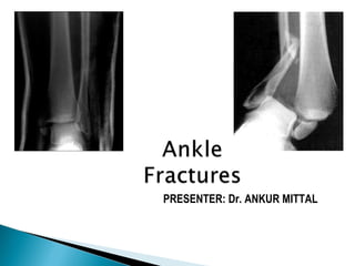 Ankle fractures final