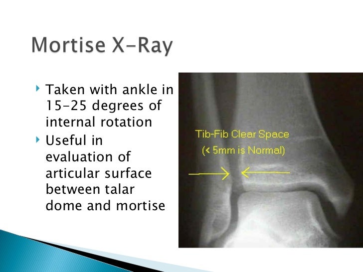 Ankle fractures final