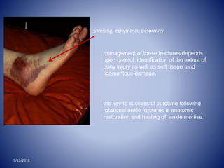 Swelling, echymosis, deformity
management of these fractures depends
upon careful identification of the extent of
bony injury as well as soft tissue and
ligamentous damage.
the key to successful outcome following
rotational ankle fractures is anatomic
restoration and healing of ankle mortise.
5/12/2018
 