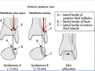 Tibiofibular clear space Tibiofibular overlap
5/12/2018
 