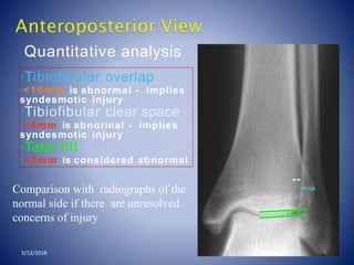 Quantitative analysis
◦Tibiofibular overlap
◦< 1 0 m m is abnormal - implies
syndesmotic injury
◦Tibiofibular clear space
◦> 5 m m is abnormal - implies
syndesmotic injury
◦Talar tilt
◦> 2 m m is considered abnormal
Comparison with radiographs of the
normal side if there are unresolved
concerns of injury
5/12/2018
 