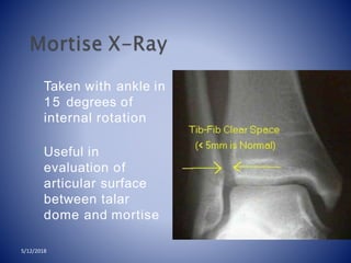 Taken with ankle in
15 degrees of
internal rotation
Useful in
evaluation of
articular surface
between talar
dome and mortise
5/12/2018
 