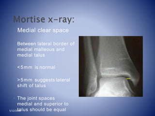 Medial clear space
◦ Between lateral border of
medial malleous and
medial talus
◦ <5mm is normal
◦ >5mm suggests lateral
shift of talus
◦ The joint spaces
medial and superior to
talus should be equal5/12/2018
 