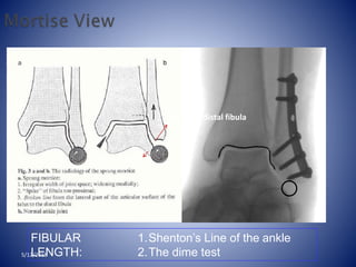 Recess in distal fibula
lateral process
of talus
FIBULAR
LENGTH:
1.Shenton’s Line of the ankle
2.The dime test5/12/2018
 