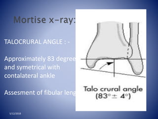 5/12/2018
TALOCRURAL ANGLE : -
Approximately 83 degrees
and symetrical with
contalateral ankle
Assesment of fibular length
 