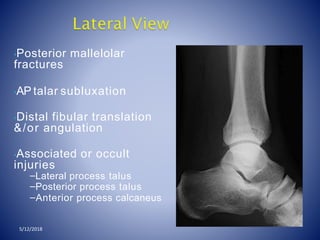 •Posterior mallelolar
fractures
•AP talar subluxation
•Distal fibular translation
&/or angulation
•Associated or occult
injuries
–Lateral process talus
–Posterior process talus
–Anterior process calcaneus
5/12/2018
 