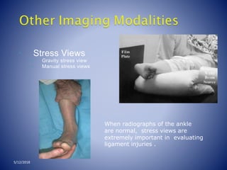 • Stress Views
– Gravity stress view
– Manual stress views
5/12/2018
When radiographs of the ankle
are normal, stress views are
extremely important in evaluating
ligament injuries .
 