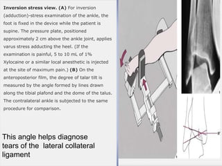 Inversion stress view. (A) For inversion
(adduction)-stress examination of the ankle, the
foot is fixed in the device while the patient is
supine. The pressure plate, positioned
approximately 2 cm above the ankle joint, applies
varus stress adducting the heel. (If the
examination is painful, 5 to 10 mL of 1%
Xylocaine or a similar local anesthetic is injected
at the site of maximum pain.) (B) On the
anteroposterior film, the degree of talar tilt is
measured by the angle formed by lines drawn
along the tibial plafond and the dome of the talus.
The contralateral ankle is subjected to the same
procedure for comparison.
This angle helps diagnose
tears of the lateral collateral
ligament5/12/2018
 