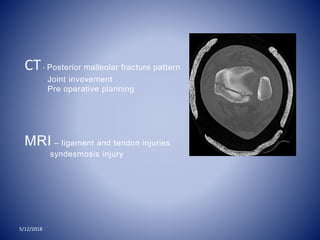 5/12/2018
CT- Posterior malleolar fracture pattern
Joint invovement
Pre operative planning
MRI – ligament and tendon injuries
syndesmosis injury
 