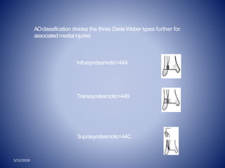 5/12/2018
AOclassification divides the three Danis Weber types further for
associated medial injuries
Infrasyndesmotic=44A
Transsyndesmotic=44B
Suprasyndesmotic=44C
v
 