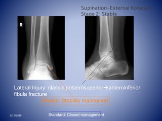Lateral Injury: classic posterosuperioranteroinferior
fibula fracture
Medial: Stability maintained
Standard: Closed management5/12/2018
 